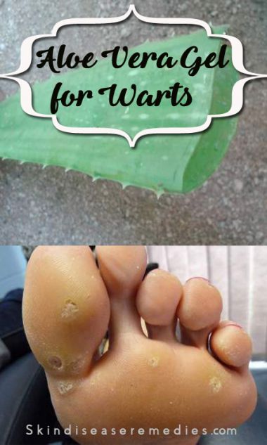 aloe-vera-gel-for-warts