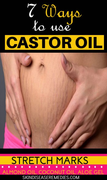 is castor oil good for stretch marks