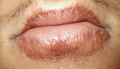 7 Home Remedies for Itchy Lips - Skin Disease Remedies