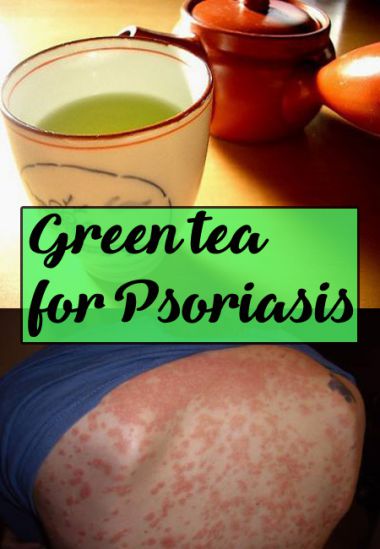 green-tea-for-psoriasis
