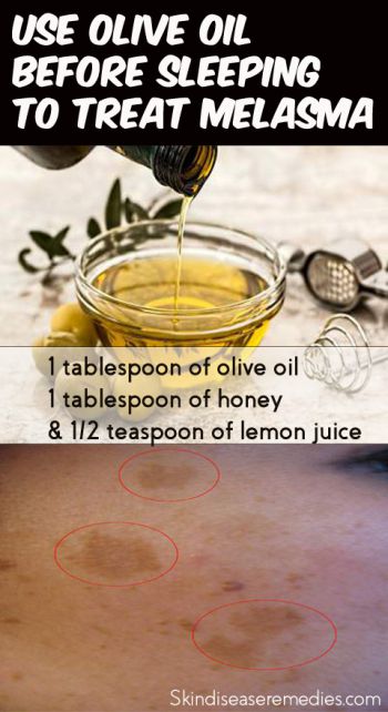 olive-oil-for-melasma