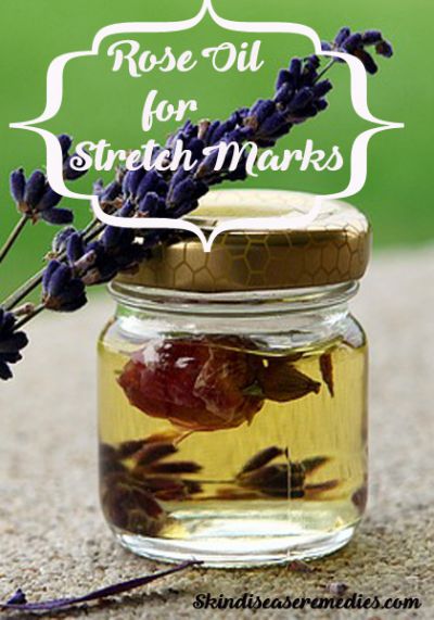 rose-oil-for-stretch-marks