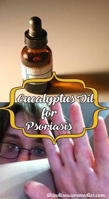 eucalyptus-oil-for-psoriasis