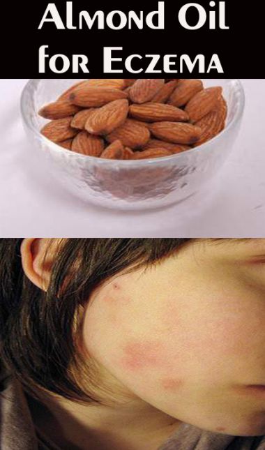How to Use Almond Oil for Eczema – 10 DIY Methods