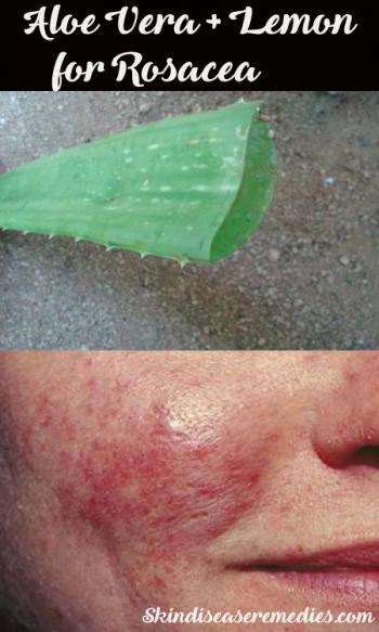 aloe-vera-for-rosacea