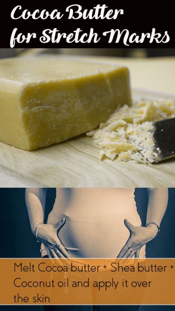 cocoa-butter-for-stretch-marks