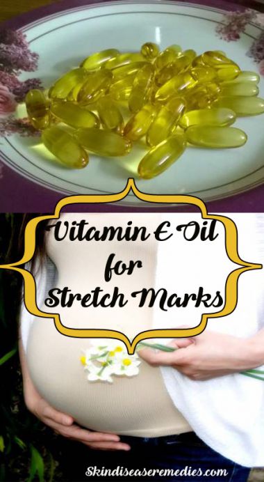 vitamin-e-oil-prevent-stretch-marks