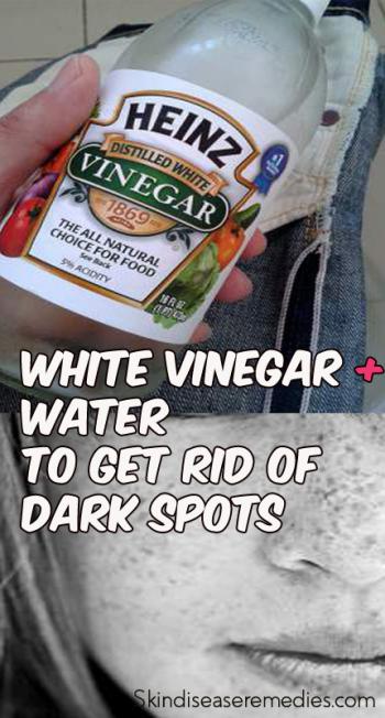 Is White Vinegar Good For Spots