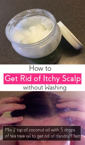 how to get rid of itchy scalp without washing hair