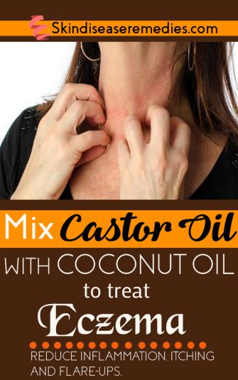 castor oil for eczema