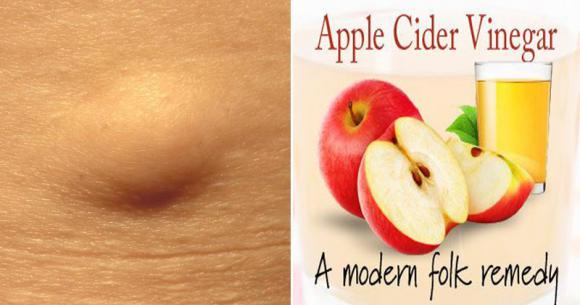apple cider vinegar for lipoma