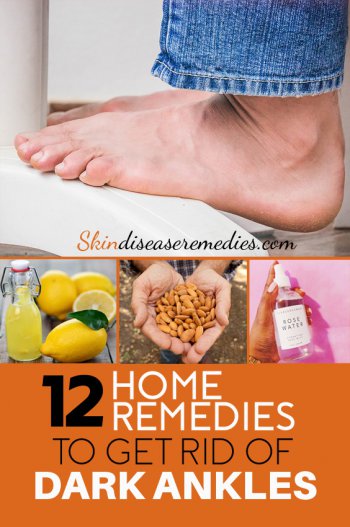 home remedies to get rid of thick dark ankles