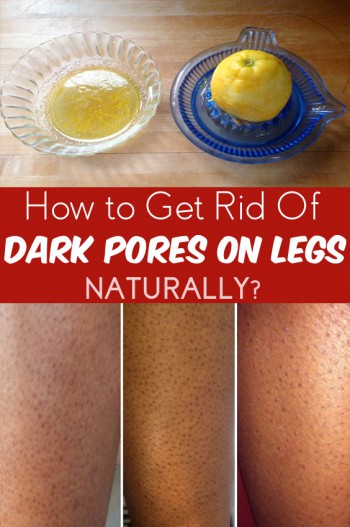 how to get rid of dark pores on legs fast