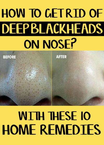 stubborn deep blackheads on nose