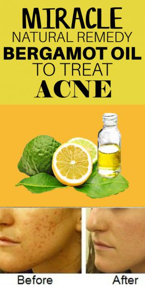 bergamot essential oil for acne