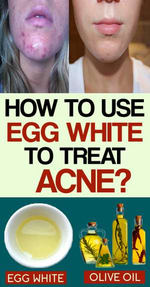 egg white for acne