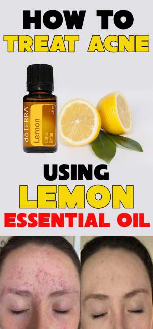 lemon essential oil for acne