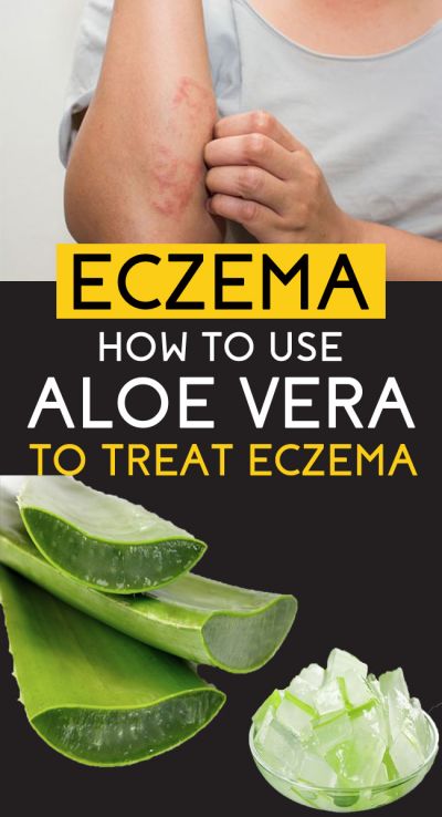 aloe vera for eczema