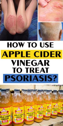 apple cider vinegar for psoriasis