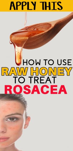 honey for rosacea