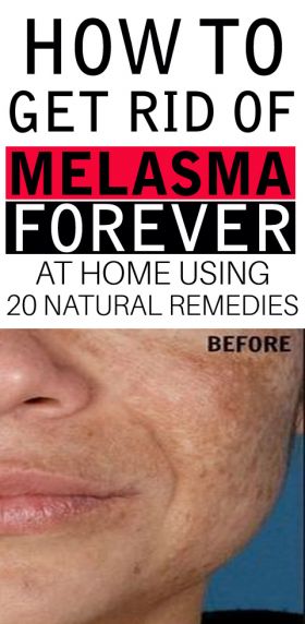 how to get rid of melasma