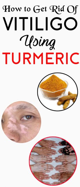 turmeric for vitiligo