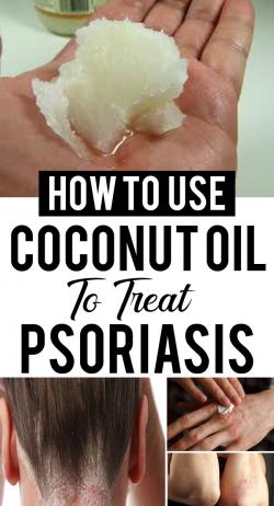How to Use Coconut Oil for Psoriasis and Scalp Psoriasis?