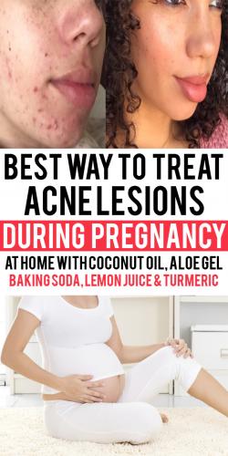 acne treatment during pregnanc