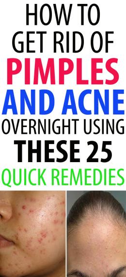 How to Get Rid of Pimples and Acne Overnight Using These 25 Quick