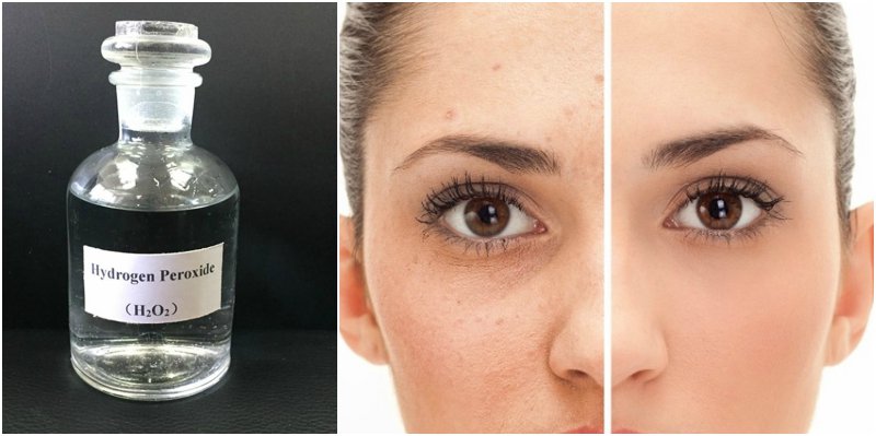 7 Recipes using Hydrogen Peroxide for Skin-Whitening