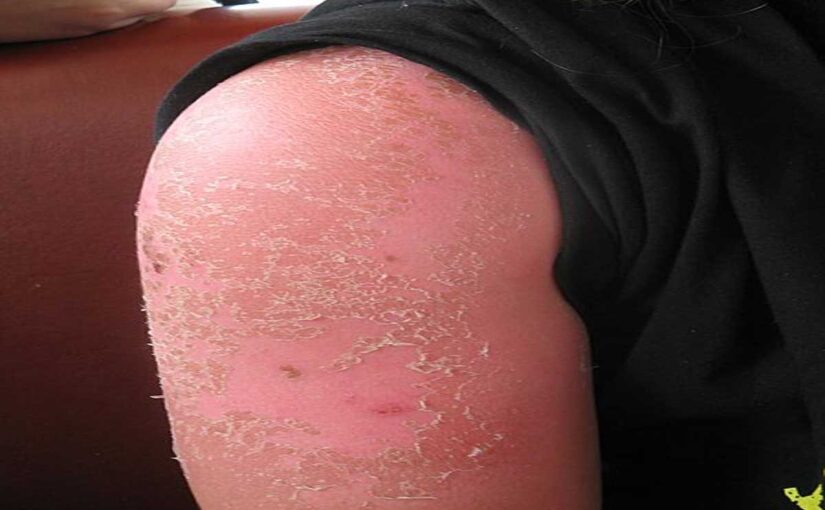 Sunburn vs. Sun Poisoning: Symptoms, Remedies, & Prevention