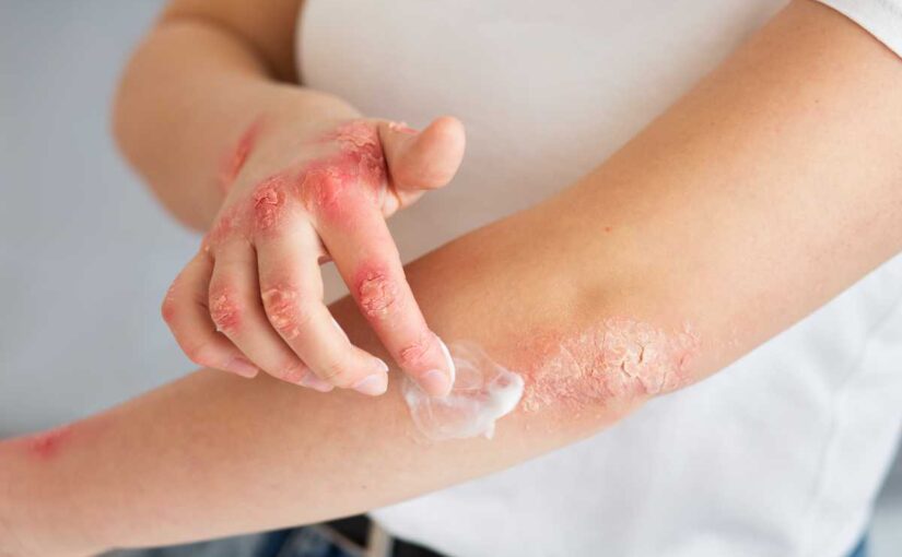 Chemical Burn: Common Causes, Symptoms, and Treatment