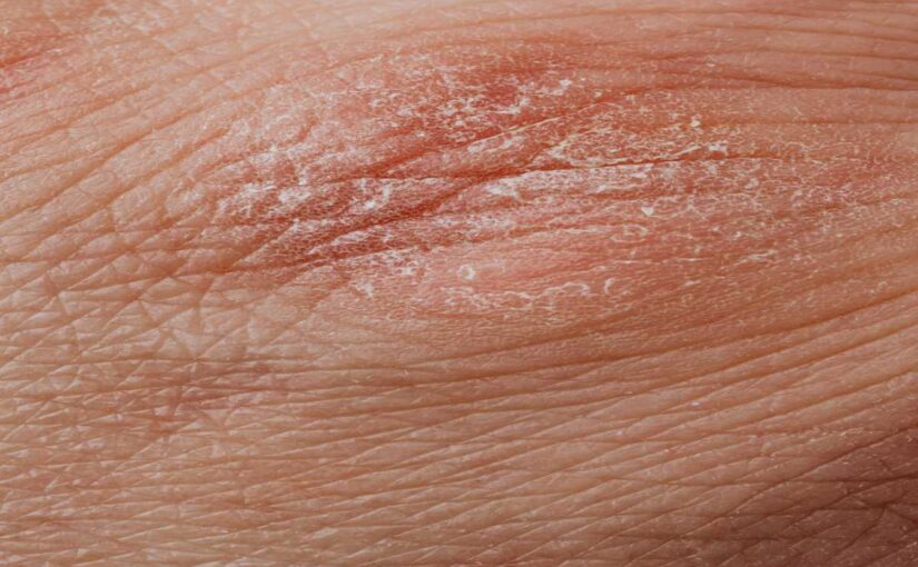 9 Best Home Remedies for Flaky Skin and Prevention Tips