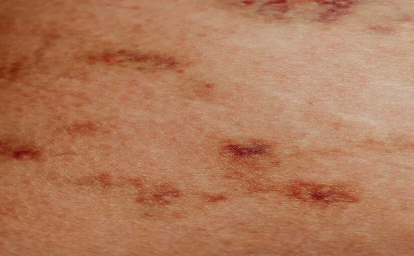 Red Spots on Skin: Easy Causes, Treatments, and Solutions